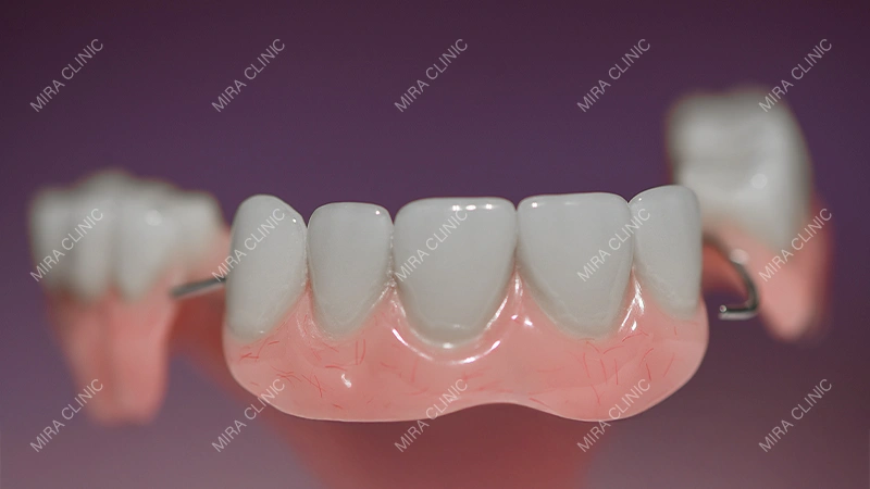 Temporary Teeth During the Implant